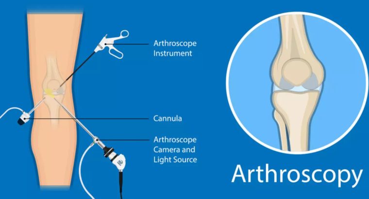 Arthroscopy in Hindi – आर्थोस्कोपी सर्जरी क्या होती हैं?