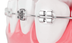 Dental Braces Clinic In Dubai