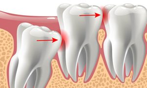 Wisdom Tooth Extraction Clinic In Dubai