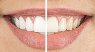 Teeth Whitening Service In Dubai