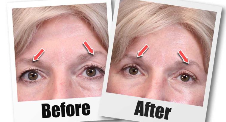 Eyelid Surgery Seattle – Blepharoplasty Seattle