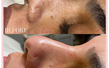 Skin Rejuvenation – Fade Away Laser and Skin Centre