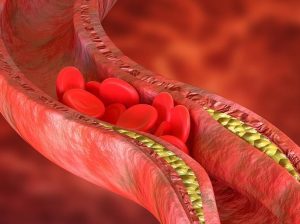 Sickle Cell Treatment in India