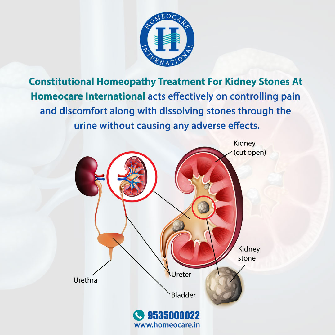 Homeopathy Treatment for Kidney Stones | Kidney Stones Treatment in Homeopathy – Homeocare International